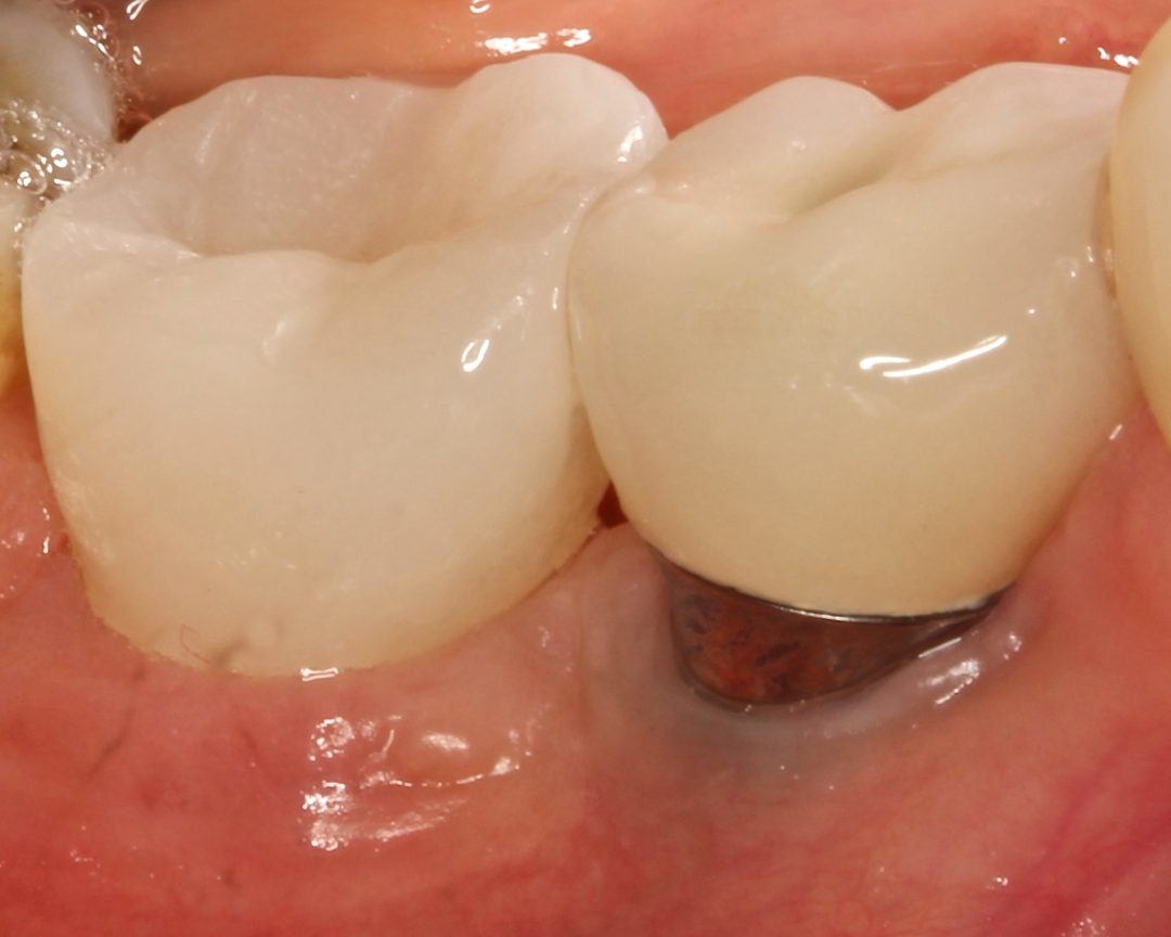 What You Need to Know About Ceramic vs Titanium Dental Implants