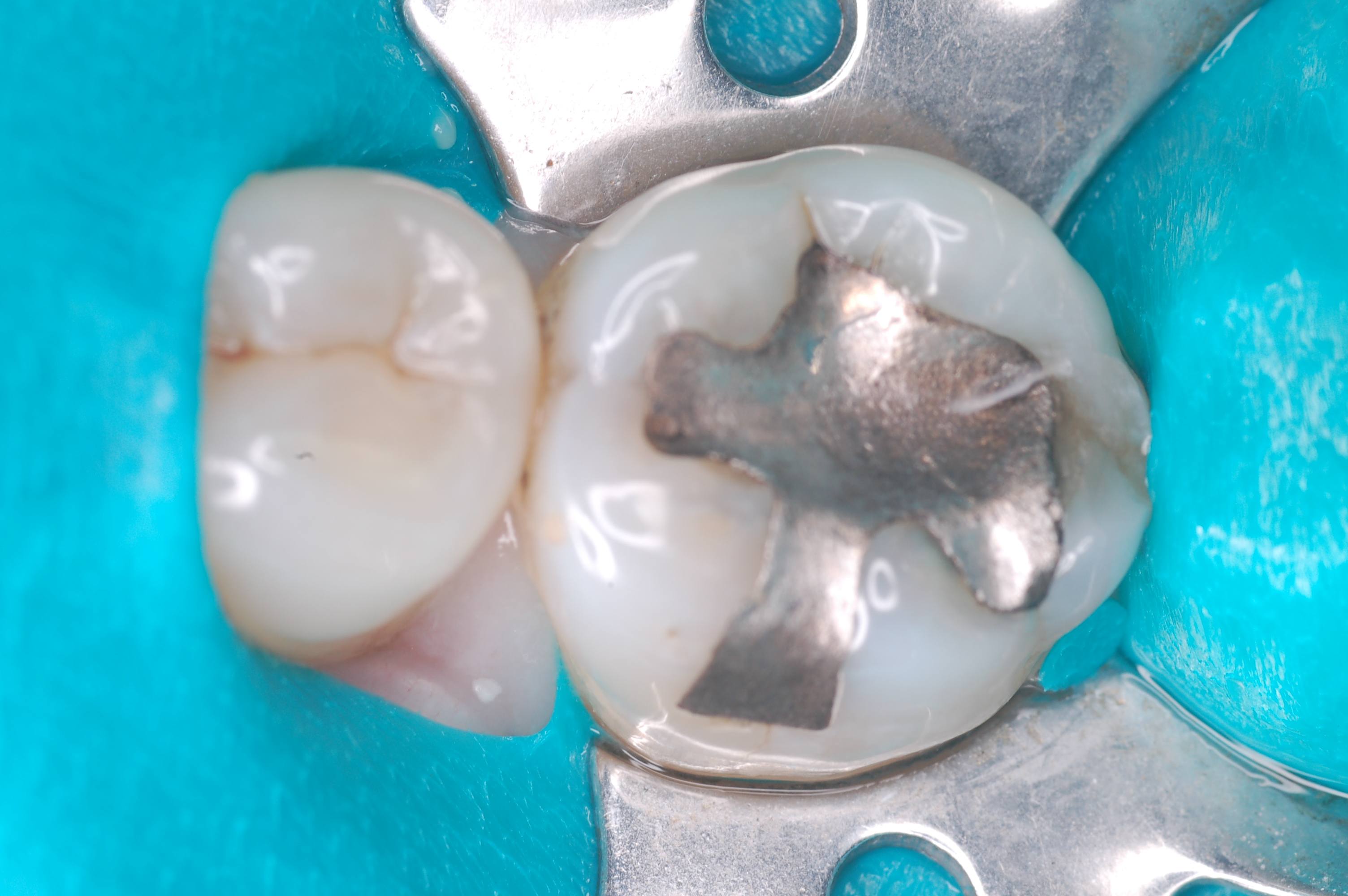 Safe Silver Filling Removal Remove Toxic Amalgam