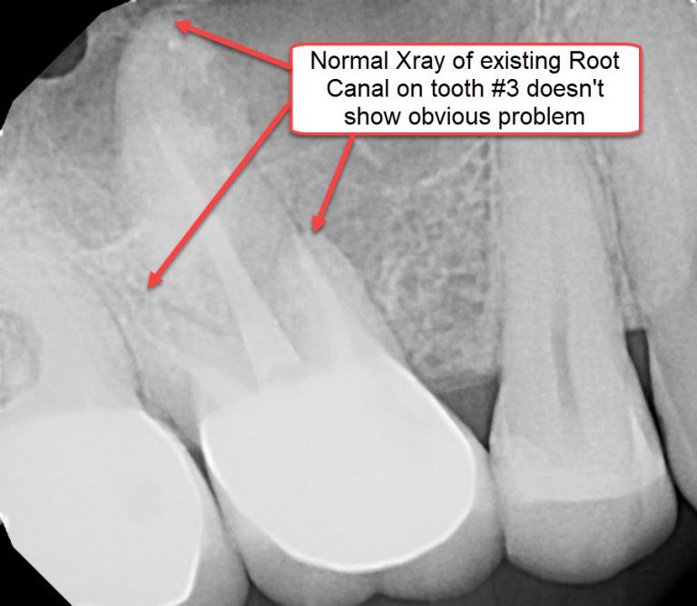 Infected Root Canals and What To Do About Them Integrative Dentistry