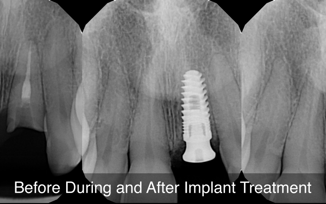 Inflammation May Cause Failure in Extractions, Root Canals and Implants