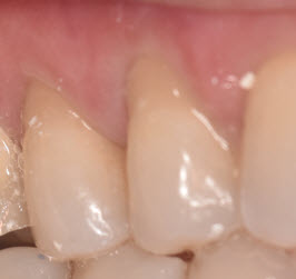 Gum Recession